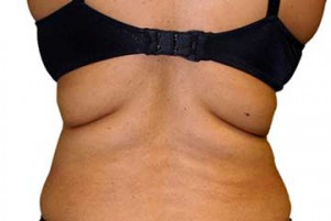 U-Lipo Upper Back Tuck