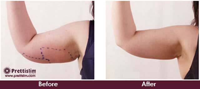 Arm Tuck Before and After