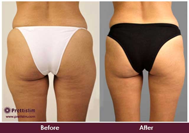 Before and After Buttock Lift