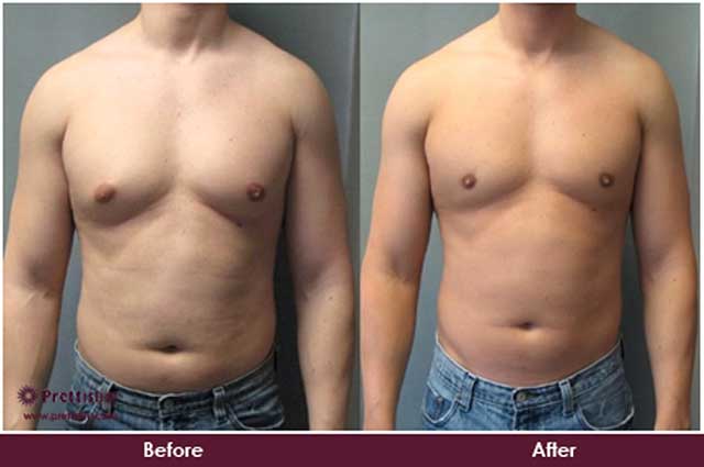 Before and After Gynecomastia