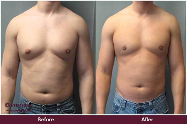 Gynecomastia Treatment Without Surgery in Mumbai | Prettislim