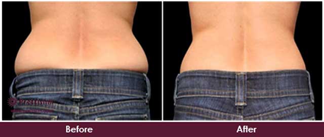 Before and After Love Handles