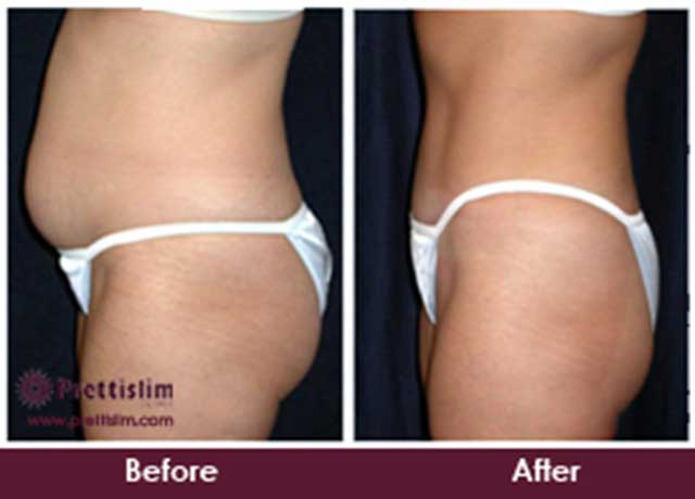 Before and After Tummy Tuck