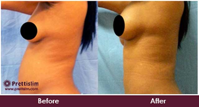 Breast Lift Before and After