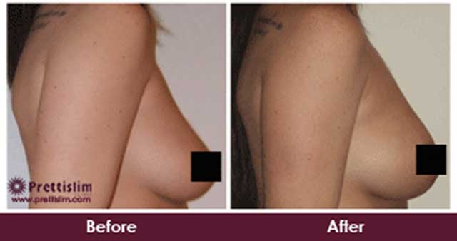 Breast Uplift Before and After