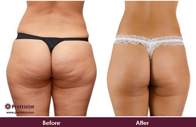 Buttock Lift Before and After