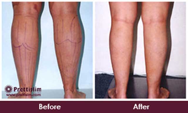 Calf Fat Reduction Before and After