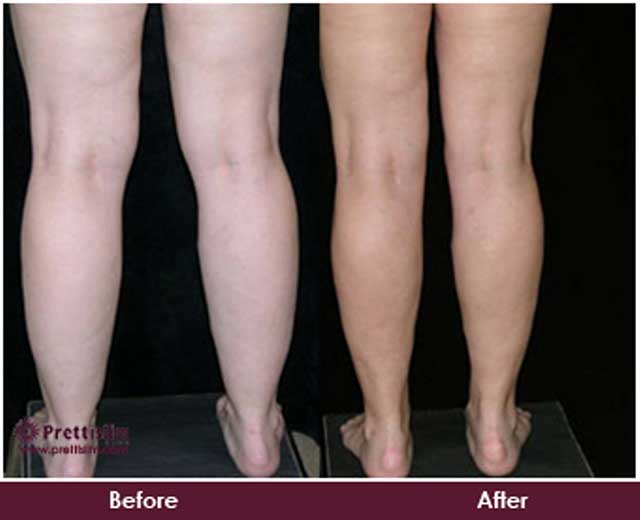 Calf Tuck Before and After