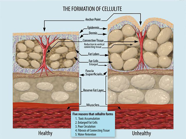 Cellulite Formation