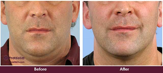 Non Surgical Double Chin Liposuction Treatment in Mumbai | Prettislim