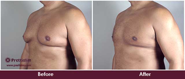 Gynecomastia Before and After