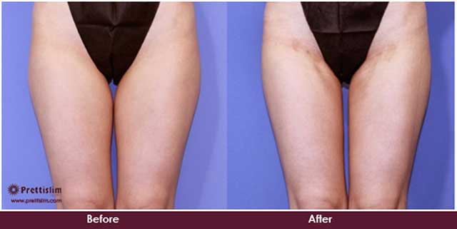 Inner thigh bulge best sale