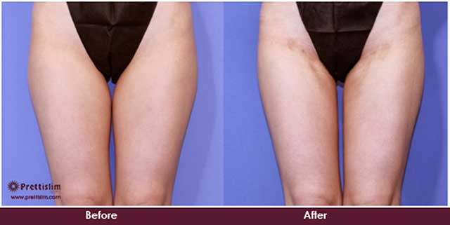 What are the average results for thigh liposuction?