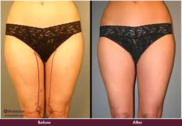 Inner Thigh Lipo Before and After