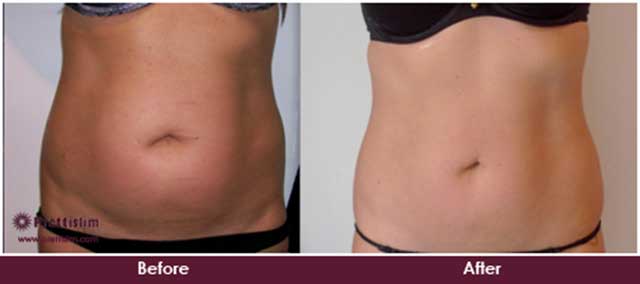 Non Surgical Tummy Tuck Before and After