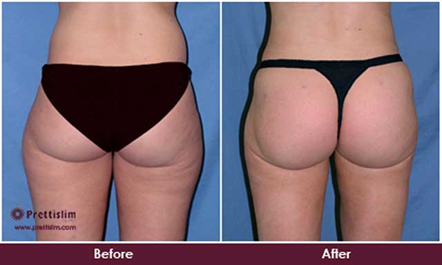 Saddlebags Before and After Saddlebags Before and After