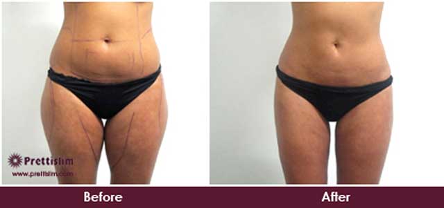 Thigh Lift Before and After