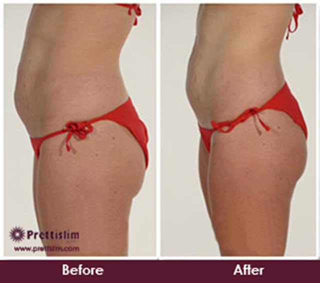 Thigh Lipo Before and After