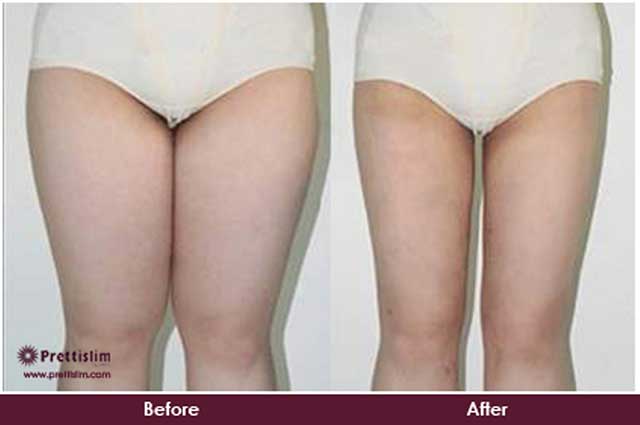 Thigh Tuck Before and After