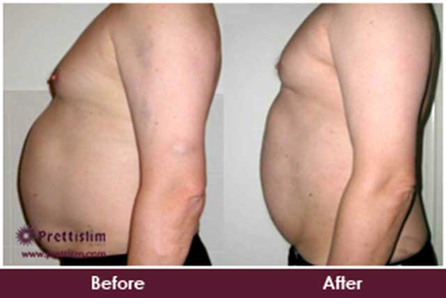 Tummy Tuck Before and After