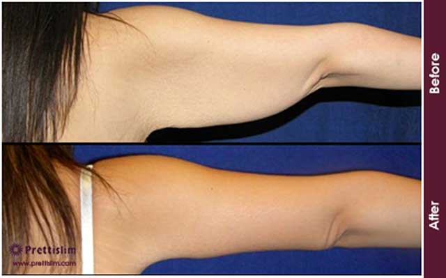 U-Lipo<sup>®</sup> Arm Tuck Before and After