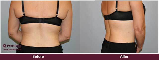 Upper Back Lipo Before and After