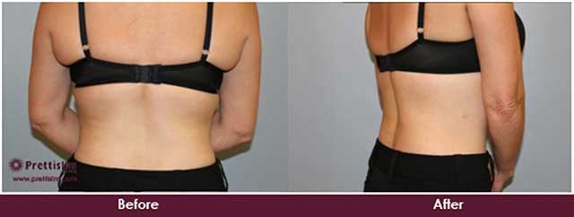 U-Lipo® Upper Back Tuck - Prettislim Clinic