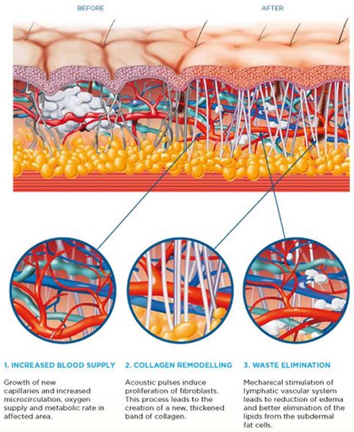 Radio Frequency Skin Tightening