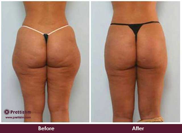 Thigh Lift Before and After Thigh Lift Before and After