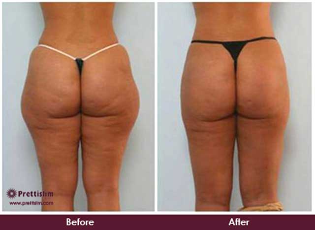 Thigh Lift Before and After