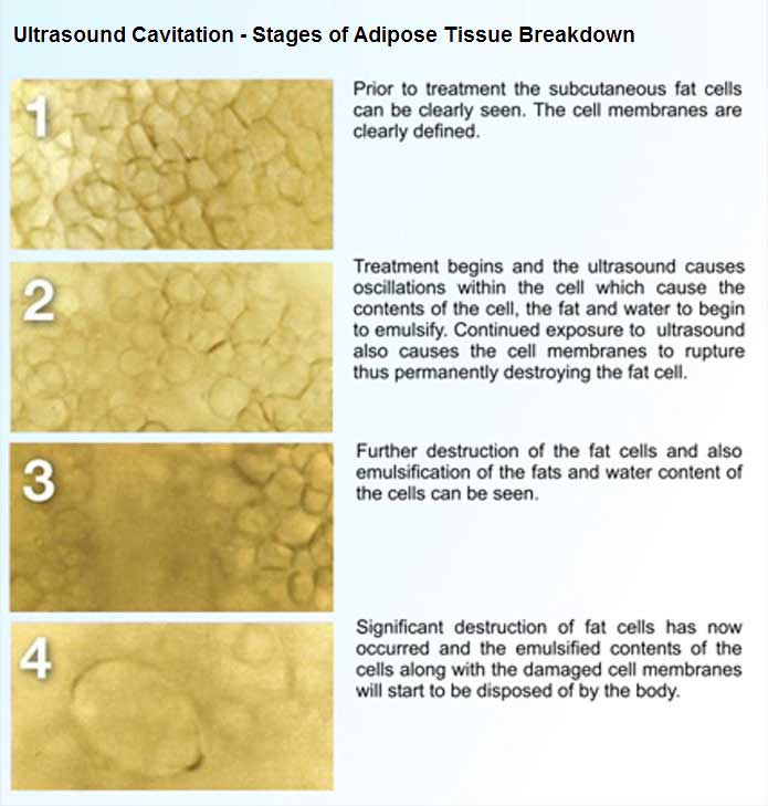 Ultrasonic Cavitation Liposuction