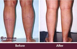 before-and-after-calf-tuck