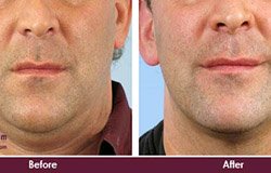 before-and-after-chin-tuck