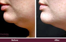 before-and-after-face-chin-tuck