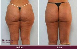 before-and-after-outer-thigh-tuck-treatment