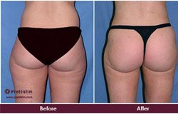 before-and-after-outer-thigh-tuck