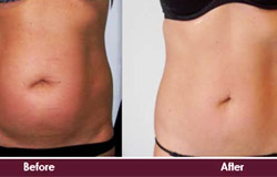 prettislim-non-surgical-tummy-tuck-before-and-after