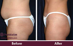prettislim-tummy-tuck-treatment-before-and-after