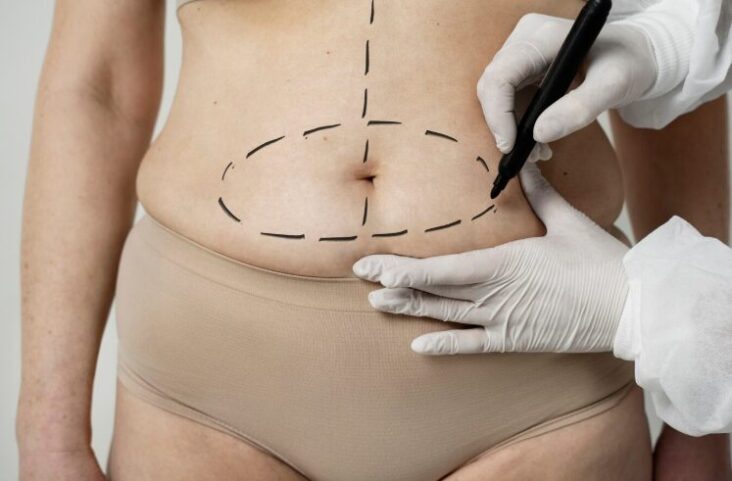 stomach fat removal surgery cost