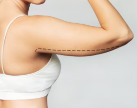 brachioplasty ( Arm Tuck )