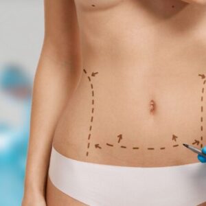 vaser liposuction