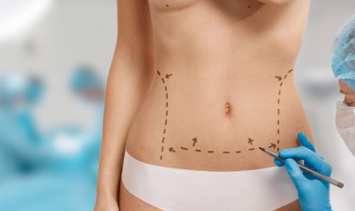 vaser liposuction