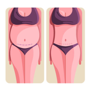 Non-Surgical Fat Removal