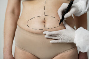 Liposuction in Mumbai: