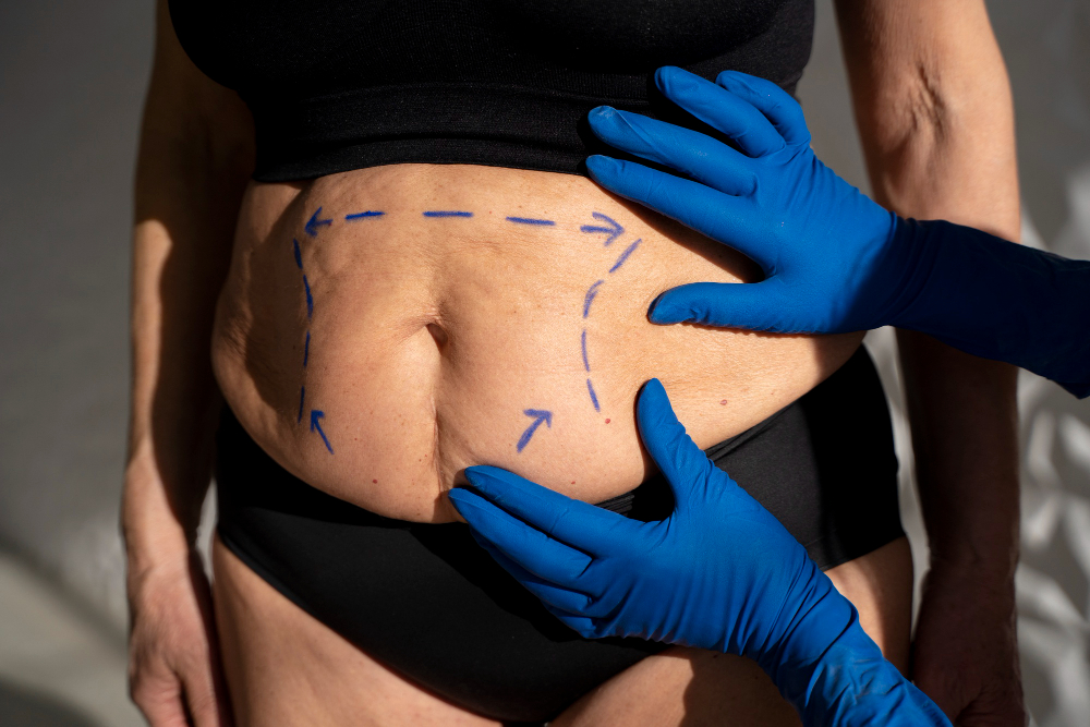 Tummy Tuck Surgery