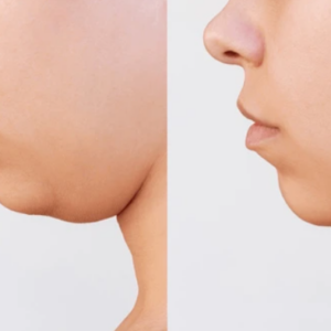 double chin liposuction before and after