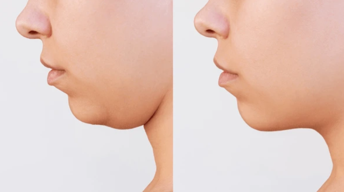 double chin liposuction before and after