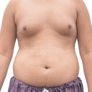 gynecomastia treatment without surgery
