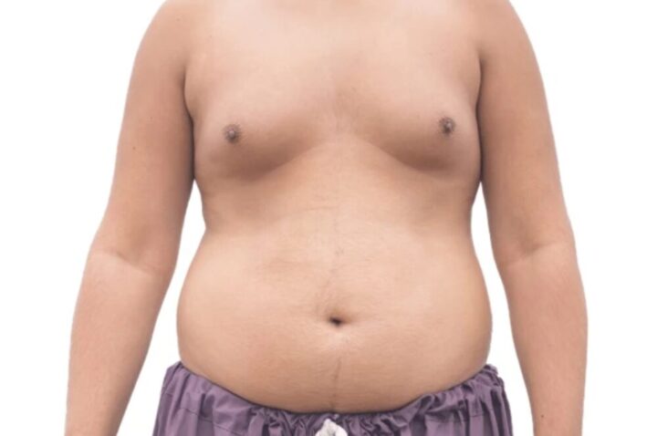 gynecomastia treatment without surgery