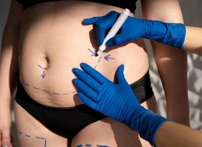 Non surgical liposuction in mumbai